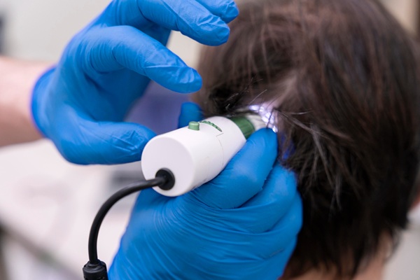 Tricoscopia para diagnóstico de alopecia - Médico capilar evaluando el cuero cabelludo de un hombre con un tricoscopio para determinar las causas de la alopecia