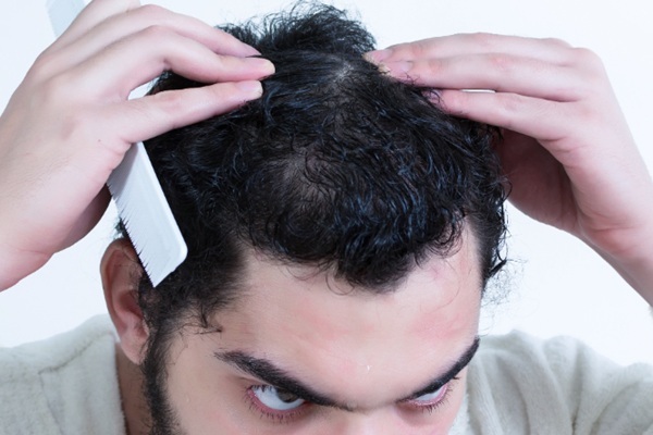 Cabello grasoso - Hombre con cuero cabelludo grasoso observando que presenta alopecia en la coronilla debido a la relación que existe entre cabello grasoso y alopecia