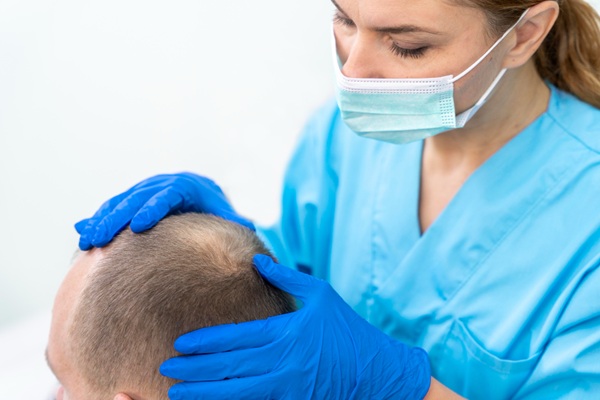 Difenciprona - Médico capilar evaluando el cuero cabelludo de un hombre con alopecia areata para recomendar un tratamiento de inmunoterapia