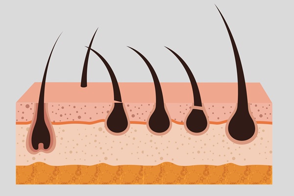 Difenciprona - Representación gráfica de los folículos pilosos recuperados por los tratamientos para la alopecia areata como la Difenciprona