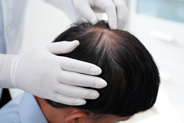 Difenciprona - Tricólogo evaluando la caída del cabello de un hombre para tratar la alopecia areata con Difenciprona