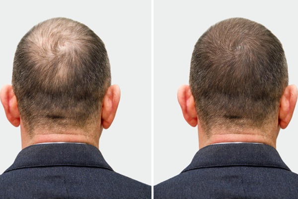 Efectos secundarios del trasplante capilar - Imagen comparativa de un hombre con alopecia antes y después del injerto capilar en la coronilla