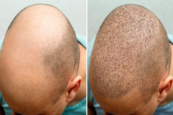 Efectos secundarios del trasplante capilar - Hombre con inflamación del cuero cabelludo luego de realizarse un trasplante cabello