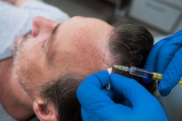 Injerto cabello costo - Tricólogo realizando un injerto de cabello a un hombre con alopecia en las entradas