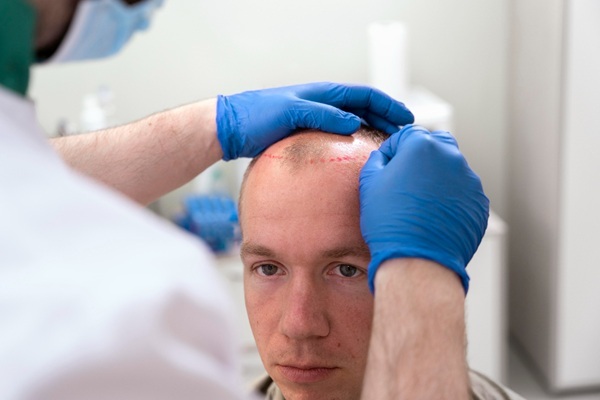 Injerto cabello costo - Médico tricólogo realizando el boceto del injerto cabello CDMX a un hombre con alopecia androgénica avanzada