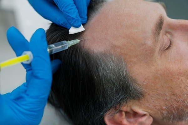 Tricólogo aplicando un tratamiento capilar a un hombre para estimular el crecimiento del pelo
