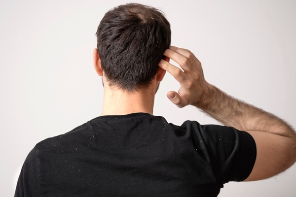 Problemas capilares más comunes - Hombre rascando su cabeza debido a la caspa en el cuero cabelludo y no saber cómo tratar los problemas capilares más comunes