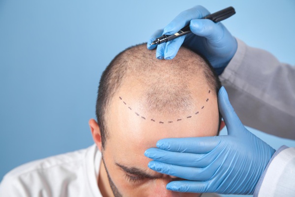 Resultados del trasplante capilar - Médico capilar realizando el boceto del trasplante cabello a un hombre con alopecia avanzada