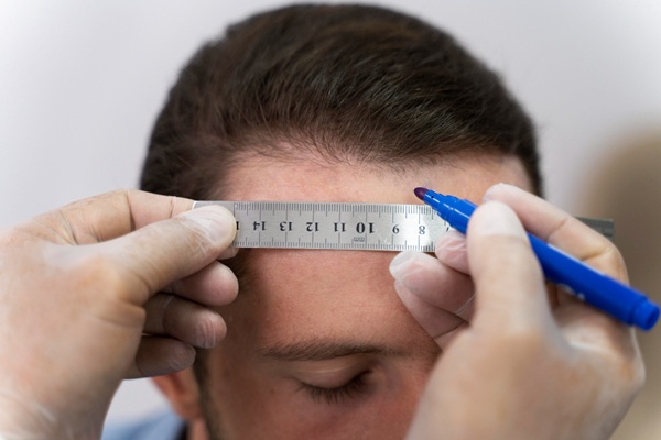 Implante de cabello - Tricólogo realizando el boceto del injerto capilar CDMX a un hombre con alopecia en las entradas para recuperar el cabello y la autoestima