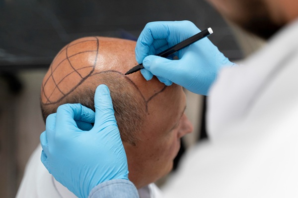 Tricólogo realizando el diseño del injerto capilar CDMX a un hombre con alopecia avanzada