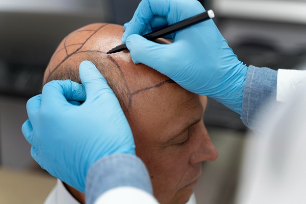 Injerto capilar precio CDMX - Tricólogo realizando el boceto del implante capilar a un hombre con alopecia para determinar el injerto de cabello costo en CDMX