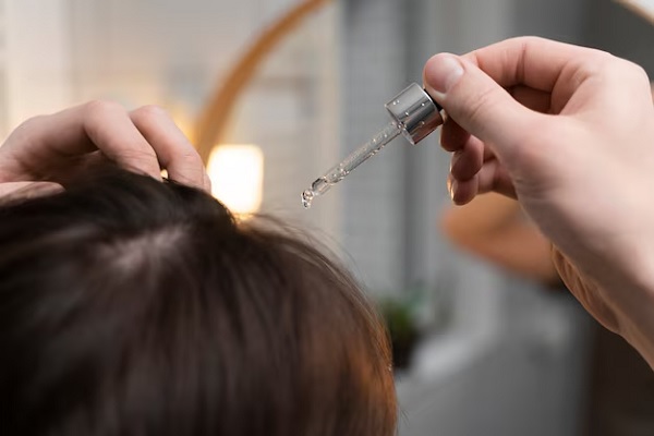 Minoxidil de los Tratamientos capilares contra la alopecia androgénica