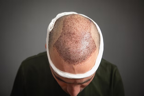 la cabeza de un hombre al que recién le acaban de hacer un Trasplante capilar