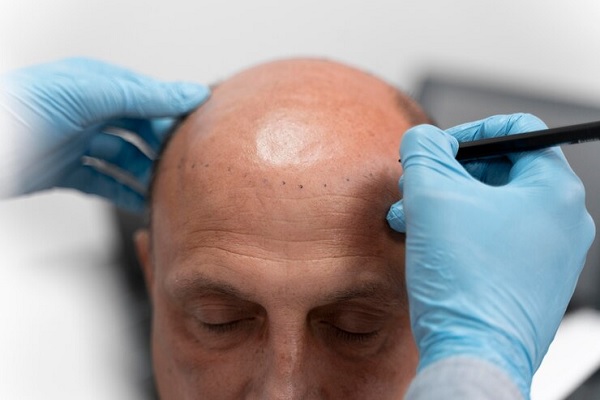 Proceso trasplante cabello - Médico capilar realizando el boceto del trasplante de cabello CDMX a un hombre con alopecia avanzada