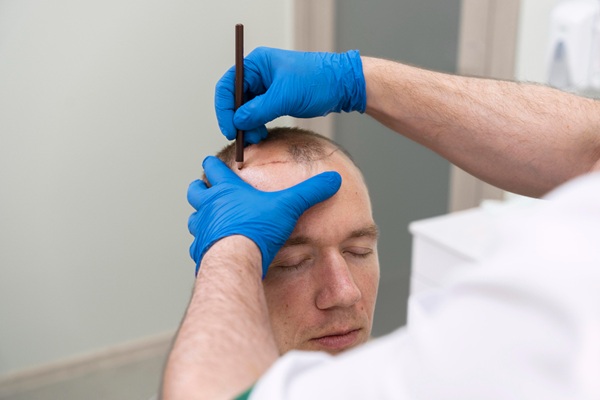 Implante capilar en las entradas - Médico tricólogo realizando el boceto del injerto cabello CDMX a un hombre con alopecia para determinar el trasplante capilar precio