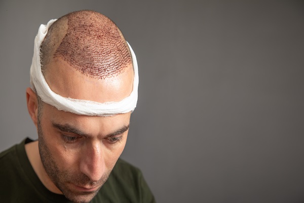 Hombre en la fase de postoperatorio de un injerto de cabello CDMX