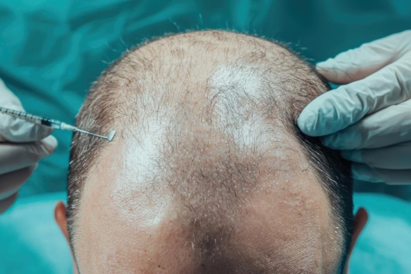Experto en injerto capilar CDMX evaluando el cuero cabelludo de un hombre con alopecia avanzada