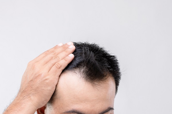 Trasplantes capilares - Hombre con alopecia en las entradas tocando su pelo con la mano antes de un injerto de cabello CDMX