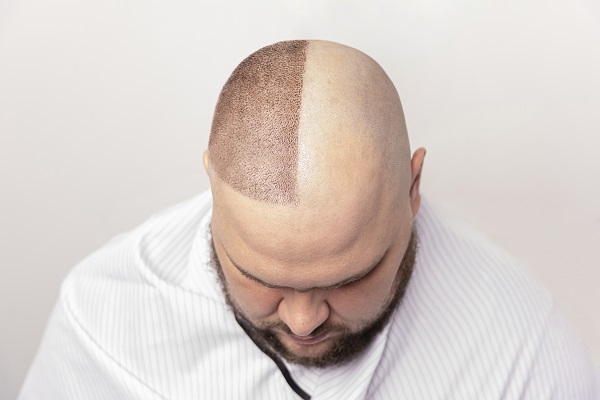Imagen comparativa del resultado del injerto de cabello en un hombre con alopecia avanzada