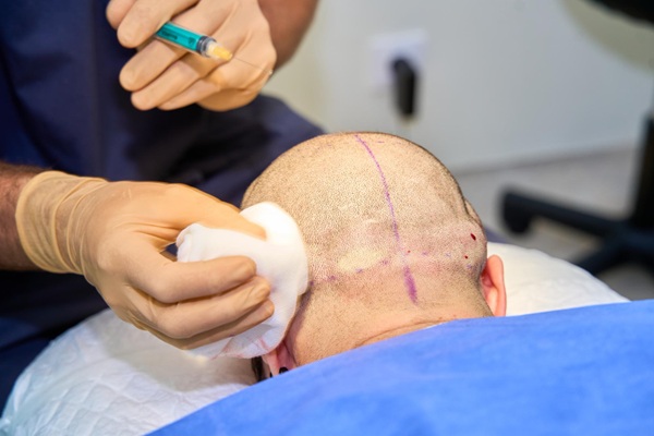 Técnica FUSS en injerto de cabello - Médico tricólogo realizando un injerto de cabello con la técnica FUSS o FUT a un hombre con alopecia avanzada