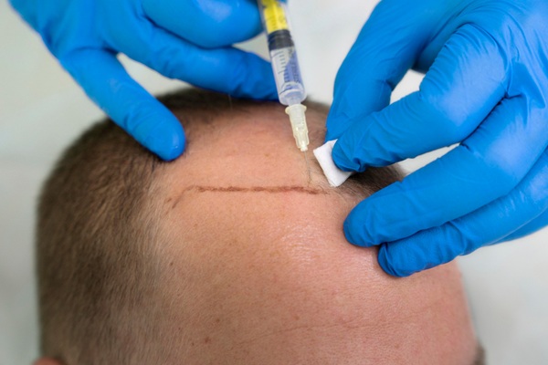 Técnica FUSS en injerto de cabello - Cirujano capilar realizando un injerto de cabello CDMX usando el método FUSS a un hombre con pérdida de pelo