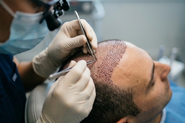 Trasplante de cabello - Cirujano realizando un injerto capilar CDMX a un hombre con pérdida de cabello en la coronilla