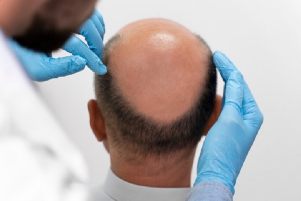 Trasplante capilar - Médico tricólogo evalúa el cuero cabelludo de un hombre con alopecia para determinar el injerto capilar precio