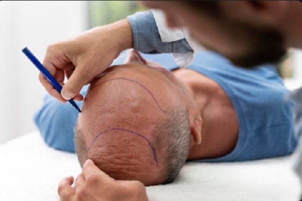 Trasplante capilar - Cirujano capilar realizando el diseño del trasplante de cabello CDMX a un hombre con alopecia androgénica