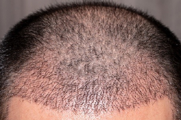 Trasplante capilar - Avance del crecimiento del injerto de cabello CDMX en un hombre con alopecia androgénica