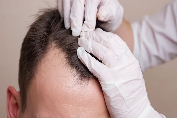 Médico evaluando a un hombre con pérdida de cabello en las entradas para realizar un injerto de cabello CDMX