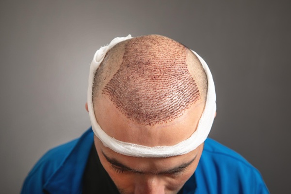 Resultados del implante capilar CDMX en un hombre con pérdida de cabello en la coronilla