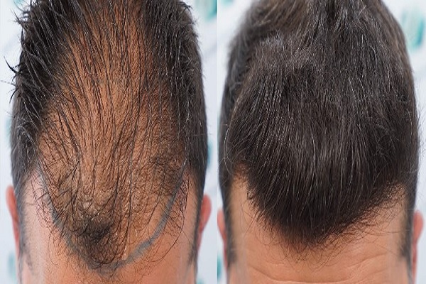 Novedades en injerto de cabello CDMX- Paciente mostrando su cabeza antes y despues del injerto de cabello CDMX