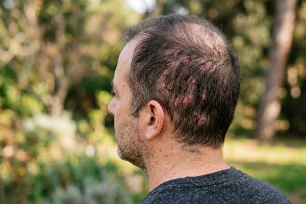 Hombre con foliculitis capilar una infección en el cuero cabelludo