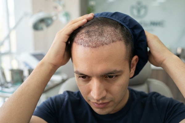 Resultado injerto de cabello - Hombre con un injerto de cabello CDMX reciente en la parte frontal de la cabeza
