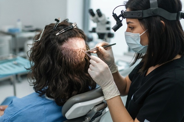 Cirujana capilar realizando un trasplante de cabello a un hombre con la técnica Long Hair FUE
